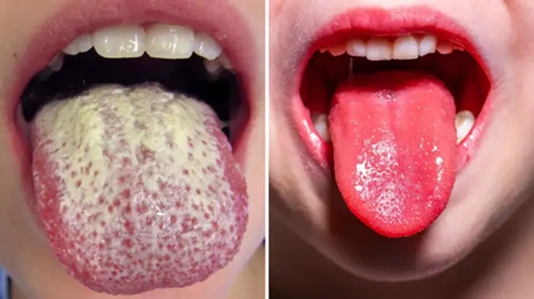 जिभ – आपल्या आरोग्याचे आरसे! रंग, पोत आणि ओलावा काय सांगतात?